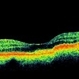 Subfoveal Bleed From Extramacular CNVM Subfoveal Bleed From Extramacular CNVM