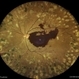 Subhyaloid Hemorrhage in a Case of Lasered Proliferative Diabetic Retinopathy