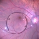 Dropped IOL on Retinal Surface (Over Macula) Dropped IOL on Retinal Surface (Over Macula)
