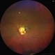 Optic disc pit Optic disc pit