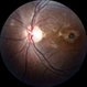 Traumatic Macular Hole Traumatic Macular Hole