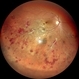 Atypical Tubercular Occlusive Peripheral Retinal Vasculitis