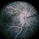 Congenital Disc Anomaly Congenital Disc Anomaly
