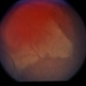 Sturge-Weber / Choroidal Hemangioma