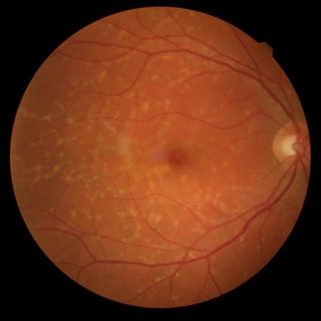 Reticular Pattern Dystrophy Retina Image Bank