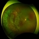 Large Retinal Tear from a Shuttlecock Injury