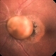 Intraocular Foreign Body Intraocular Foreign Body