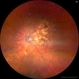 Dry Age-related Macular Degeneration and Geographic Atrophy Dry Age-related Macular Degeneration and Geographic Atrophy