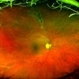 Pigment Dispersion Syndrome Pigment Dispersion Syndrome