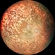 CNVM in Pan-retinal Photocoagulated Patient CNVM in Pan-retinal Photocoagulated Patient