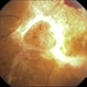 Proliferative Diabetic Retinopathy Proliferative Diabetic Retinopathy