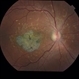 Stargardt Disease