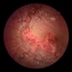 Racemose Hemangioma