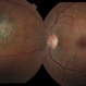 Suspicious Choroidal Nevus