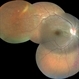 Infero Nasal Vein Occlusion