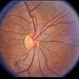 Preretinal Vascular Loop Preretinal Vascular Loop