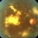 Clinically Significant Macular Edema Clinically Significant Macular Edema