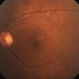 Diabetic Retinopathy Diabetic Retinopathy