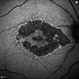 Dry AMD, Advanced Atrophic without Subfoveal Involvement Dry AMD, Advanced Atrophic without Subfoveal Involvement