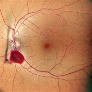 Woman presents with peripapillary hemorrhages