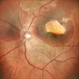 Subretinal Hemorrhage Subretinal Hemorrhage