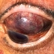 Subconjuntival IOL After Blunt Trauma