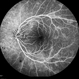 Possible Uveitis or RP Variant Possible Uveitis or RP Variant