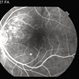 Choroidal Hemangioma Choroidal Hemangioma