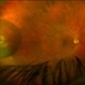 Pars Plana Cyst Mimicking a Retinal Detachment or Retinoschisis Pars Plana Cyst Mimicking a Retinal Detachment or Retinoschisis