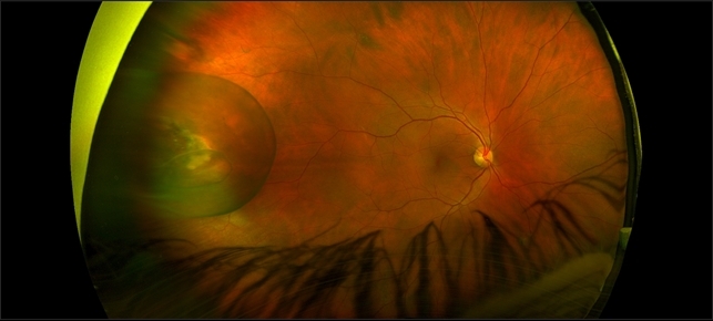 Pars Plana Cyst Mimicking a Retinal Detachment or Retinoschisis ...