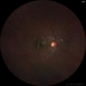 Choroidal Rupture Choroidal Rupture