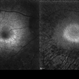 Case 2 Retinitis Pigmentosa BAF IRAF OD Case 2 Retinitis Pigmentosa BAF IRAF OD