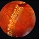 Angioma from Chronic Retinal Detachment Angioma from Chronic Retinal Detachment