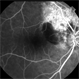 Polypoidal Choroidal Vasculopathy