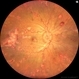 Leukemic Retinopathy and Optic Neuropathy Leukemic Retinopathy and Optic Neuropathy