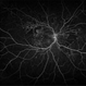 Severe Non-proliferative Diabetic Retinopathy Severe Non-proliferative Diabetic Retinopathy