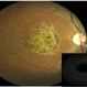 Stargardt's Dystrophy Stargardt's Dystrophy
