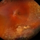 Vasoproliferative Tumor (FEVR) s/p PPV/PRP Vasoproliferative Tumor (FEVR) s/p PPV/PRP