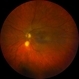 Focal Scleral Nodule Focal Scleral Nodule