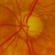 Glaucomatous Optic disc cupping