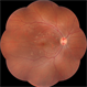 Autosomal Recessive Bestrophinopathy Autosomal Recessive Bestrophinopathy