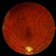 Angioma from Chronic Retinal Detachment Angioma from Chronic Retinal Detachment