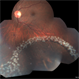 Retinal Detachment