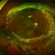 Retinitis Pigmentosa Retinitis Pigmentosa