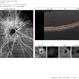 Proliferative diabetic retinopathy