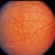 Leber's Congenital Amaurosis