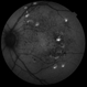 Autosomal Recessive Bestrophinopathy Autosomal Recessive Bestrophinopathy