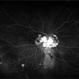 Optic Disc Hemangioblastoma Optic Disc Hemangioblastoma