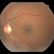 Pseudohole OS in Tamoxifen Retinopathy with Pseudocystic Foveal Cavitation