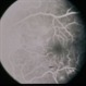 BDR / Macular Edema / Macroaneurysm BDR / Macular Edema / Macroaneurysm